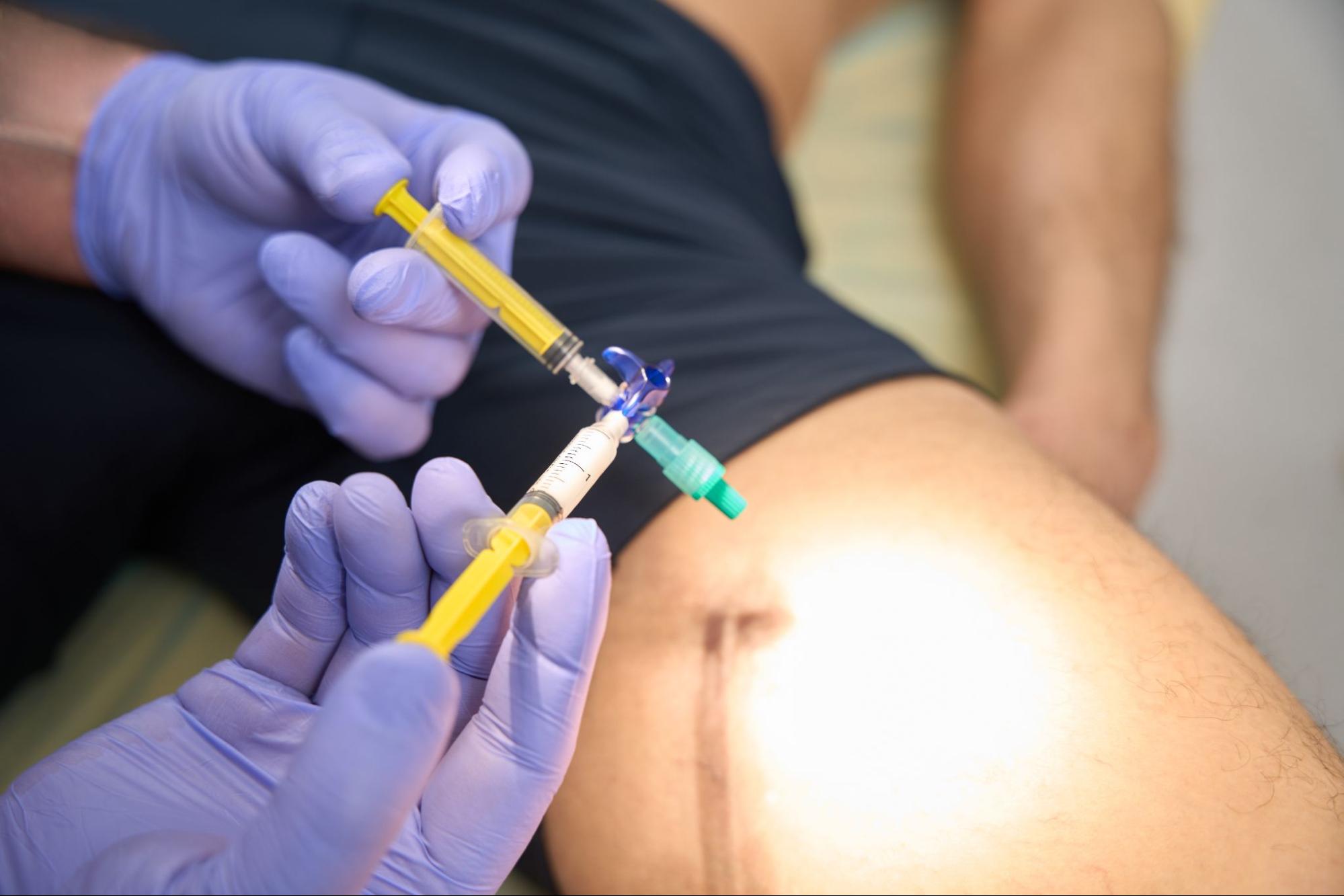 Close-up of testosterone injection syringes prepared for intramuscular administration in a man’s inner thigh